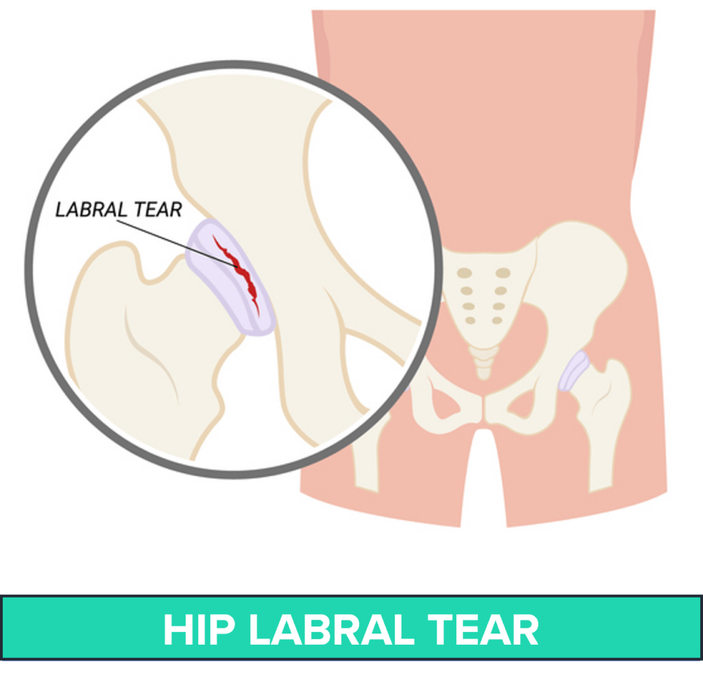 1 Non Surgical Treatment For Hip Labral Tear Matterhorn Fit