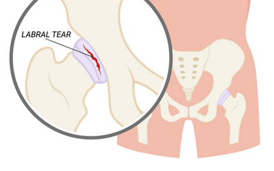 #1 Non-Surgical Treatment For Hip Labral Tear